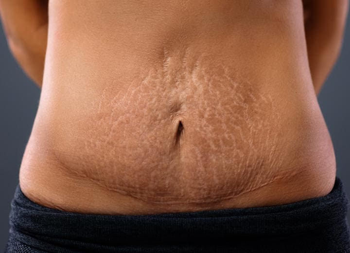 HR Plastic Sugery - Tummy stretch marks